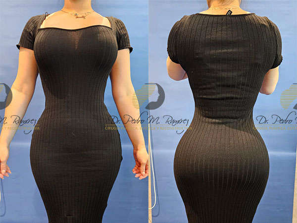 Lipoescultura en Guadalajara