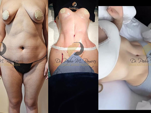 Mommy Makeover en Guadalajara